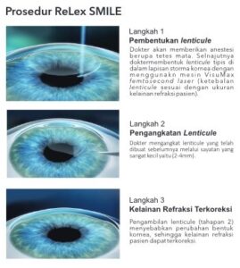 alat Bantu Penglihatan