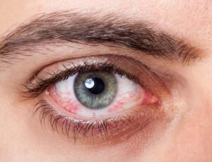 Salah satu gejala mata kelilipan adalah mata merah