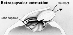 Extracapsular Cataract Extraction (ECCE)