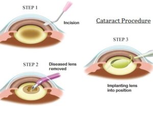 Small Incision Cataract Surgery (SICS)
