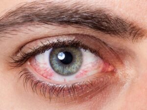 Mata Kering memicu munculnya Pterygium