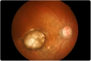 retina - degenerasi makula