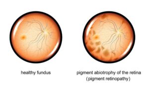 Retina - Retinitis Pigmentosa