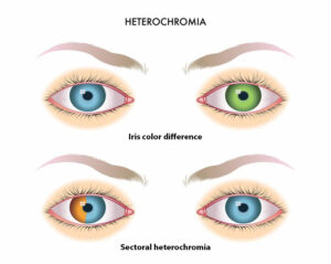 Kelainan Mata Heterochromia