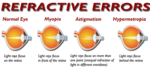 Myopia center kelainan refraksi operasi katarak refraktif