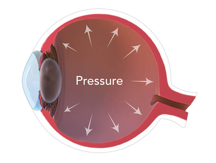 tekanan bola mata