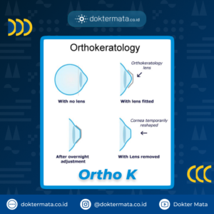 Ortho K_Cara Bebas Kacamata Minus dan Silinder