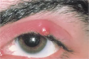 mata bintitan sembuh sendiri