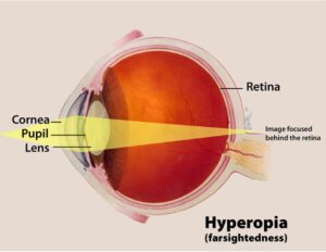 rabun dekat pada anak (hyperopia)