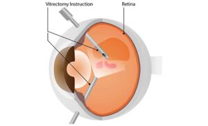 Vitrektomi (operasi mata retina)