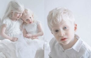 Albino Alami Masalah Mata