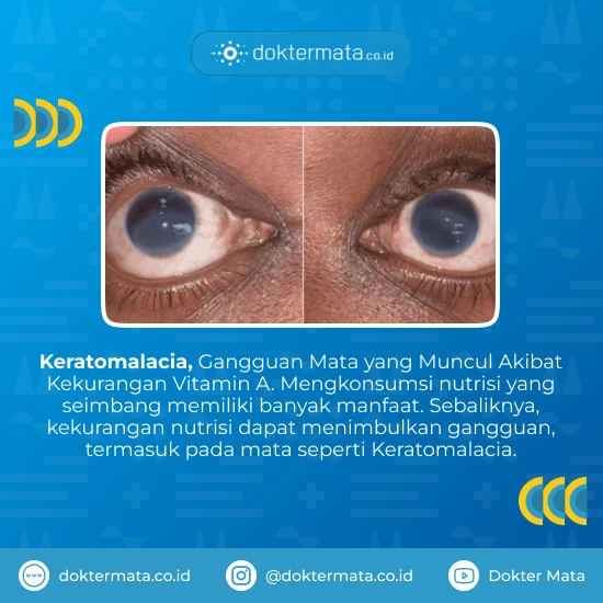 Pengertian Keratomalacia