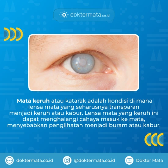 Pengertian Mata Keruh
