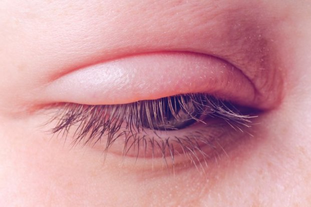 selulitis orbital