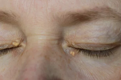 xanthelasma dan milia