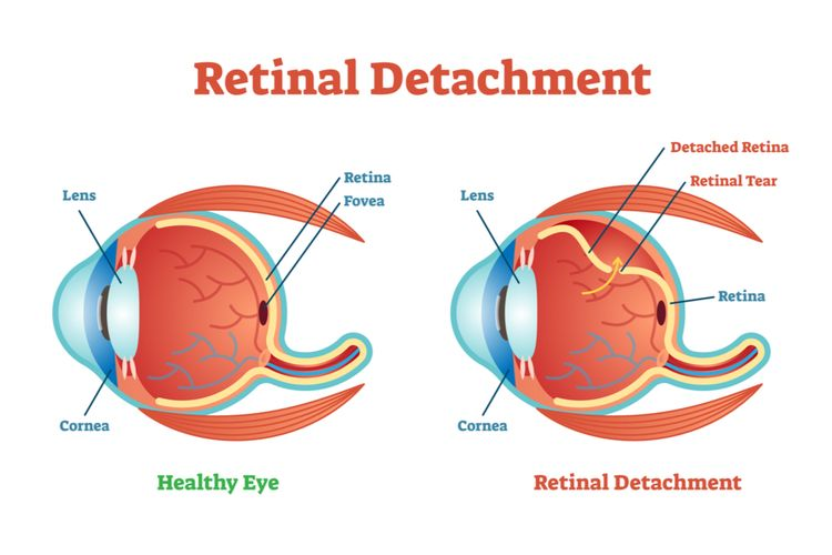 Retina Mata Rusak 