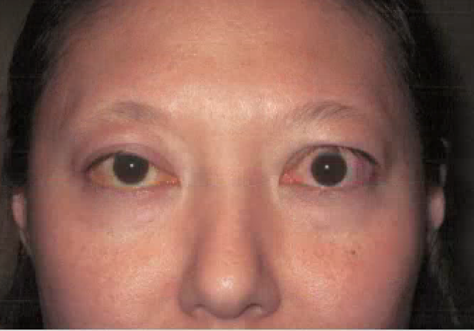 graves eye disease
