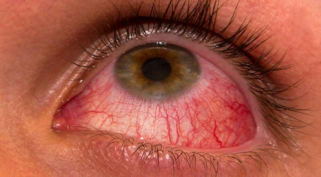 Pertanda infeksi akibat softlens