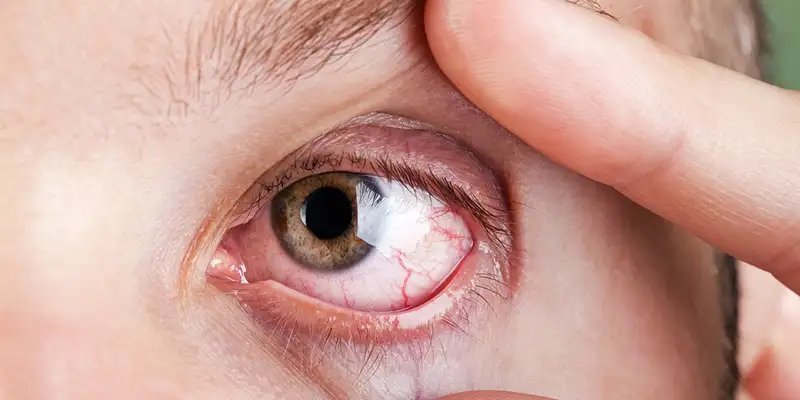 Pertanda infeksi akibat softlens