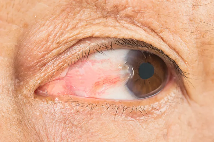 Memperlambat Pertumbuhan Pterygium