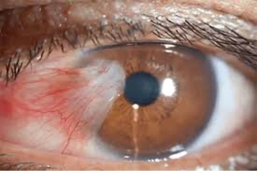 Memperlambat Pertumbuhan Pterygium