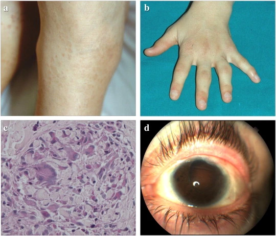 Blau Syndrome