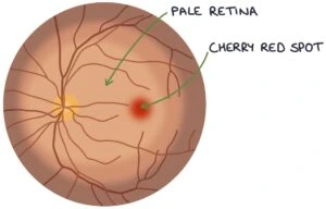central retinal artery occlusion