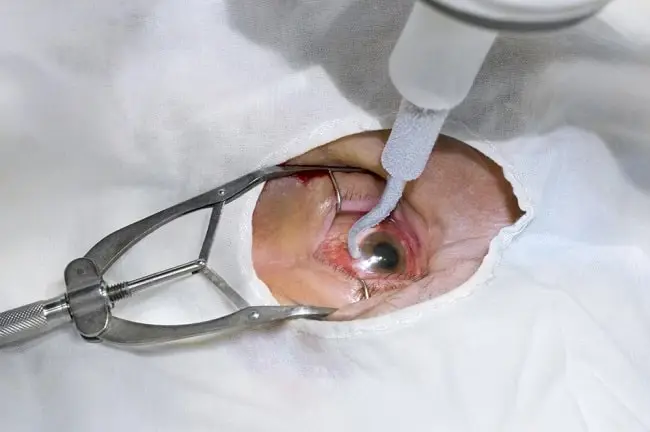 Operasi Retina Mata di Tuban