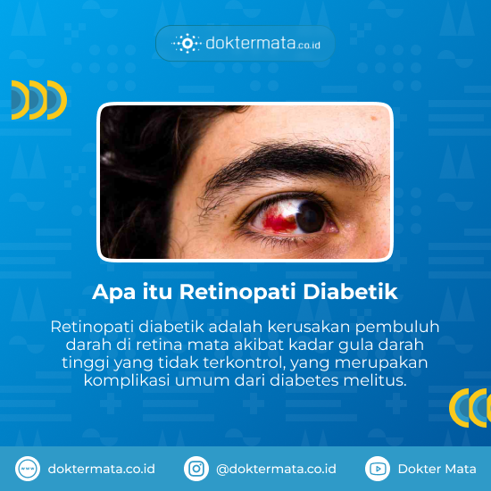 Apa itu Retinopati Diabetik - Laser Retina