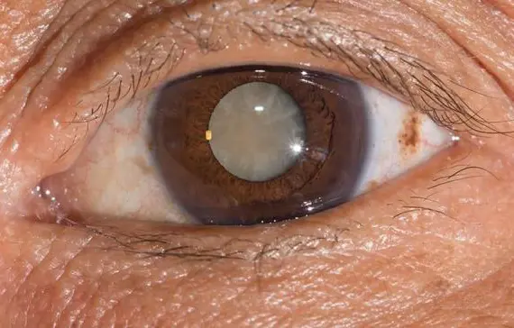 Operasi Retina Mata di Gresik