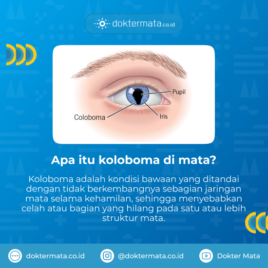 Apa itu koloboma di mata