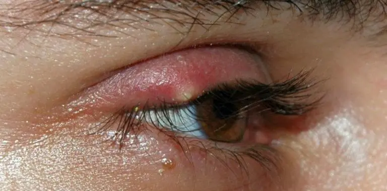 Bintitan Tidak Sembuh