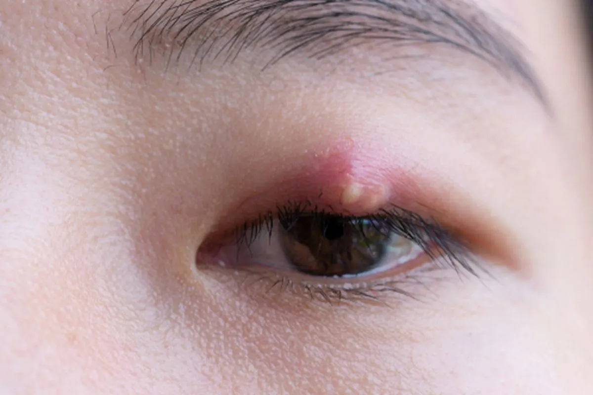 Bintitan Tidak Sembuh