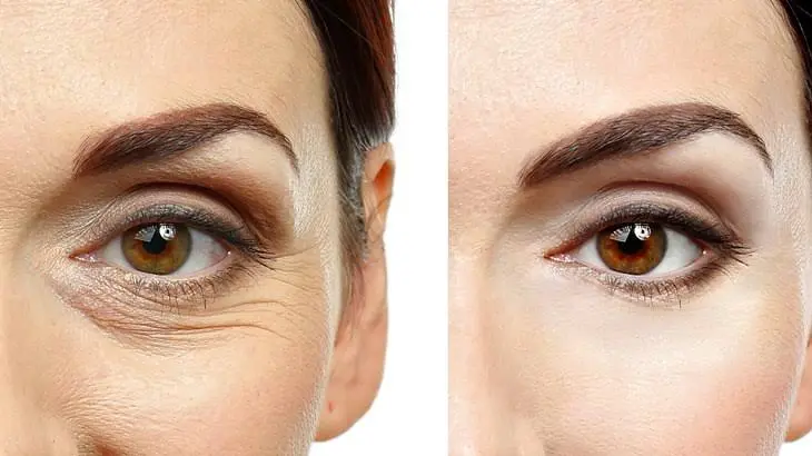 Blepharoplasty