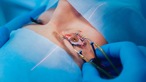 lasik ditanggung bpjs
