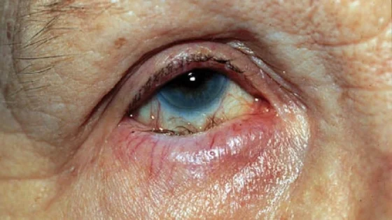 Brown McLean Syndrome