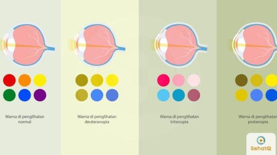 Pengobatan & Terapi Buta Warna