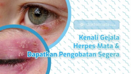 Herpes Mata