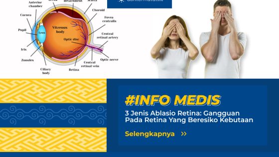Jenis Ablasio Retina Cover