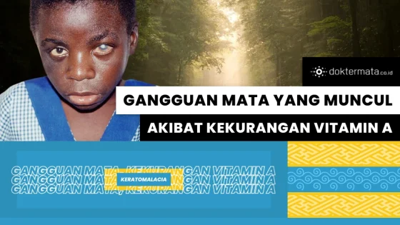 Keratomalacia, Gangguan Mata Yang Muncul Akibat Kekurangan Vitamin A