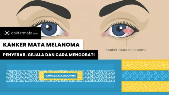 Kenali Kanker Mata Melanoma_ Penyebab, Gejala dan Cara Mengobati