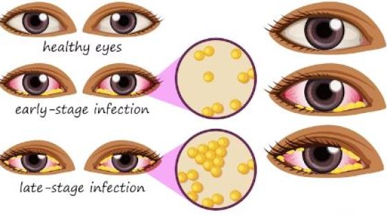 Konjungtivitis