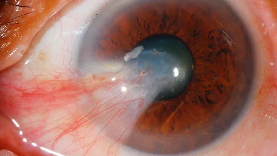 Pengobatan Pterygium