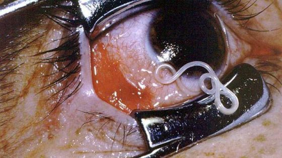 Loiasis