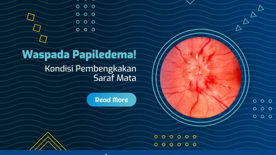 Papiledema