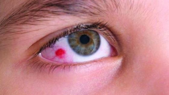 Penyakit Mata - Kanker Mata