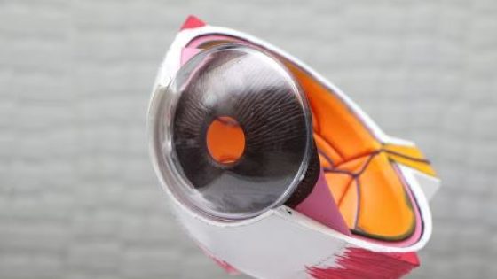 Refractive Lens Exchange (RLE)