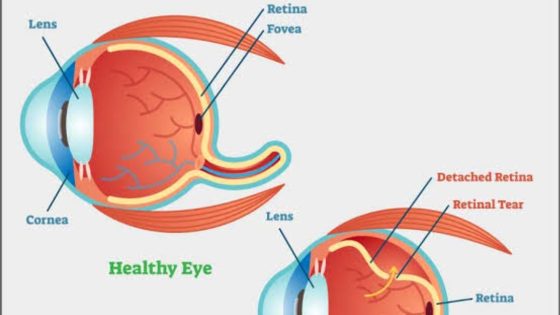 Retinitis Pigmentosa