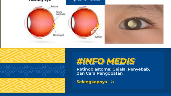 Retinoblastoma