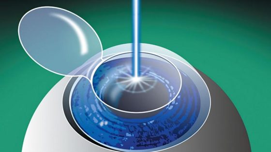 prosedur operasi lasik aman